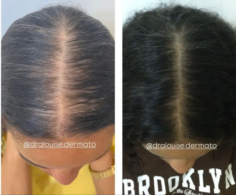 Resultado Hair Growth LC